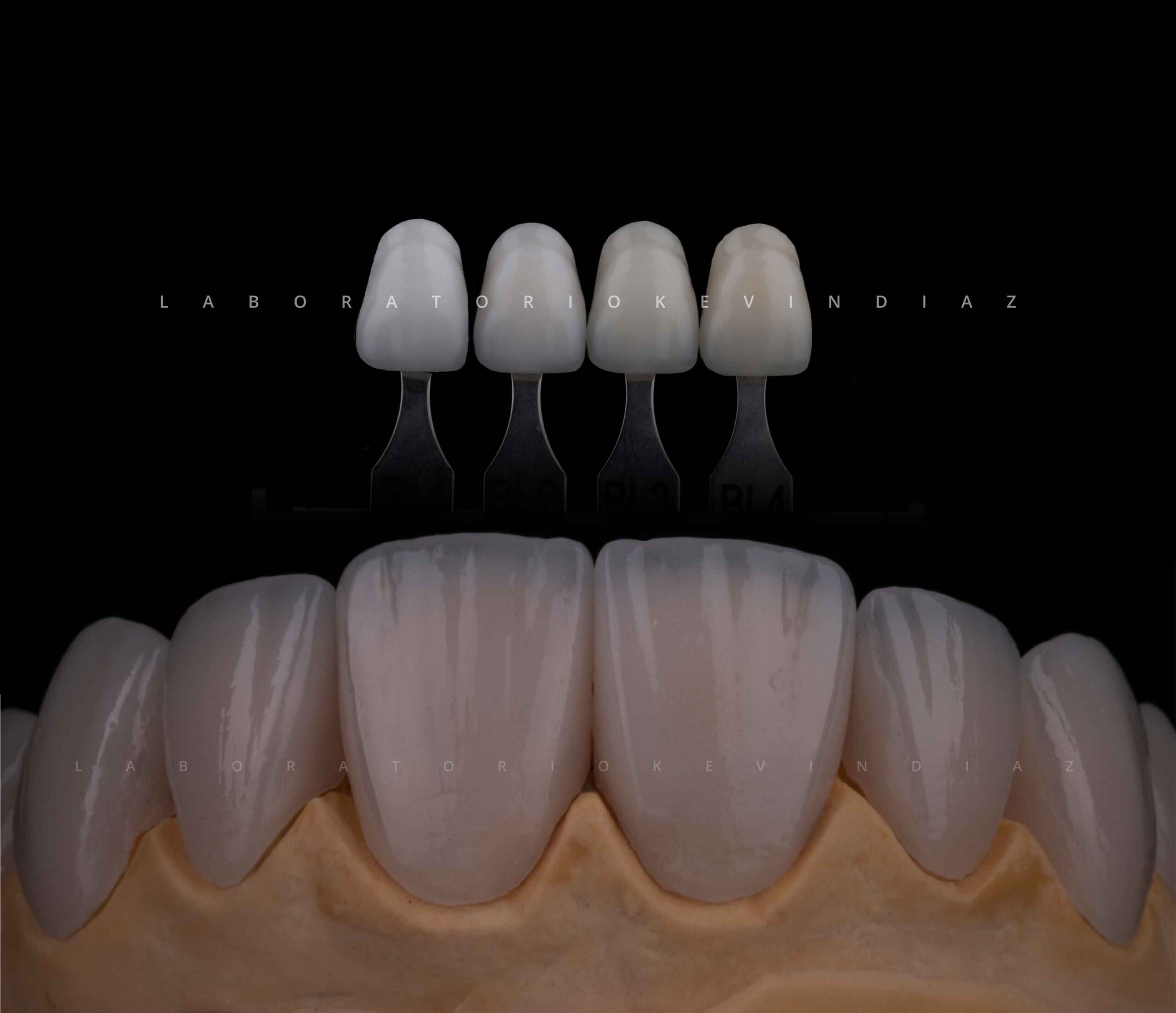 Corona metal - Laboratorio Dental 3D Natural Smile