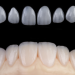 carillas de zilicato