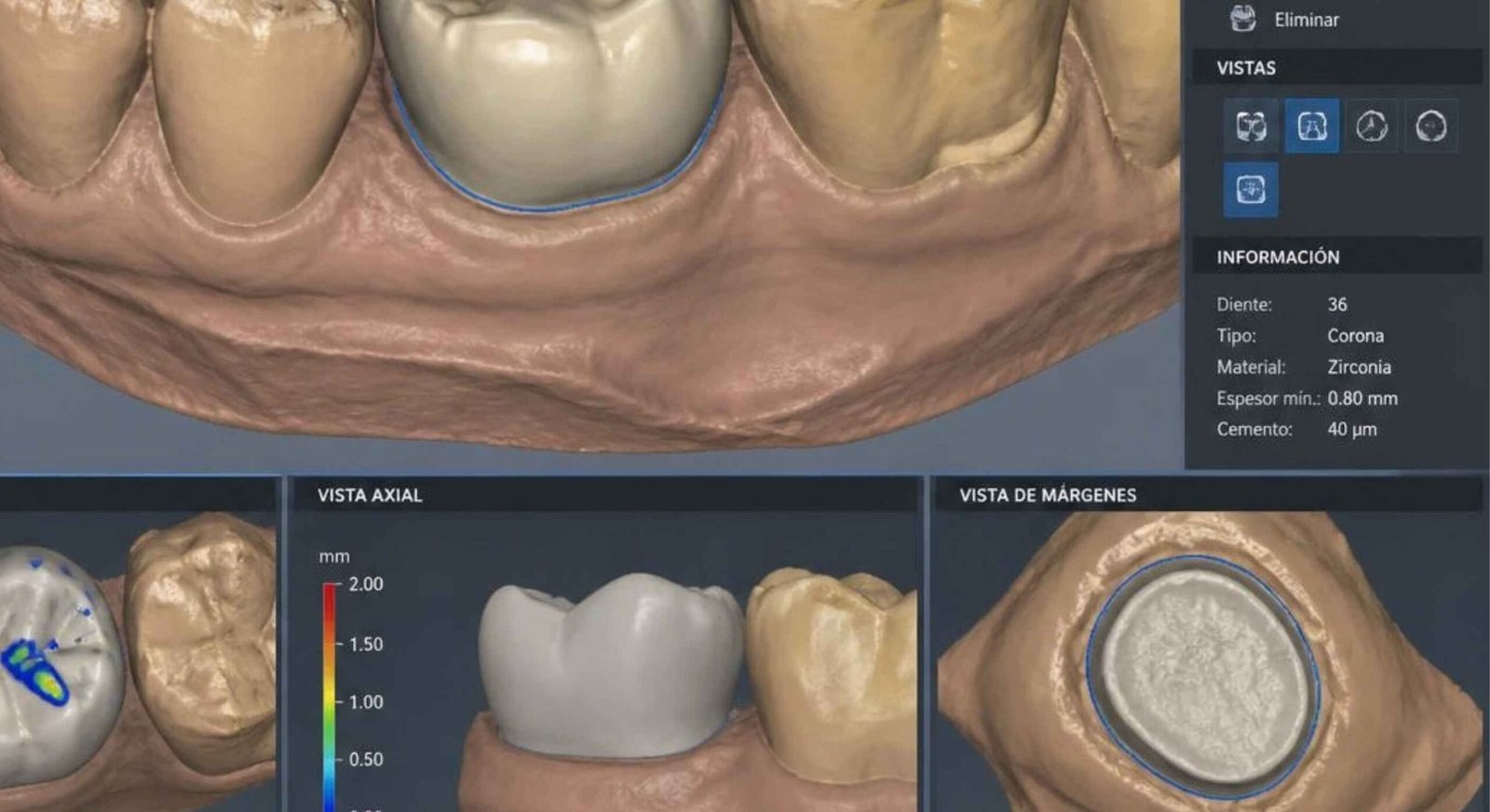Diseño CAD CAM dental